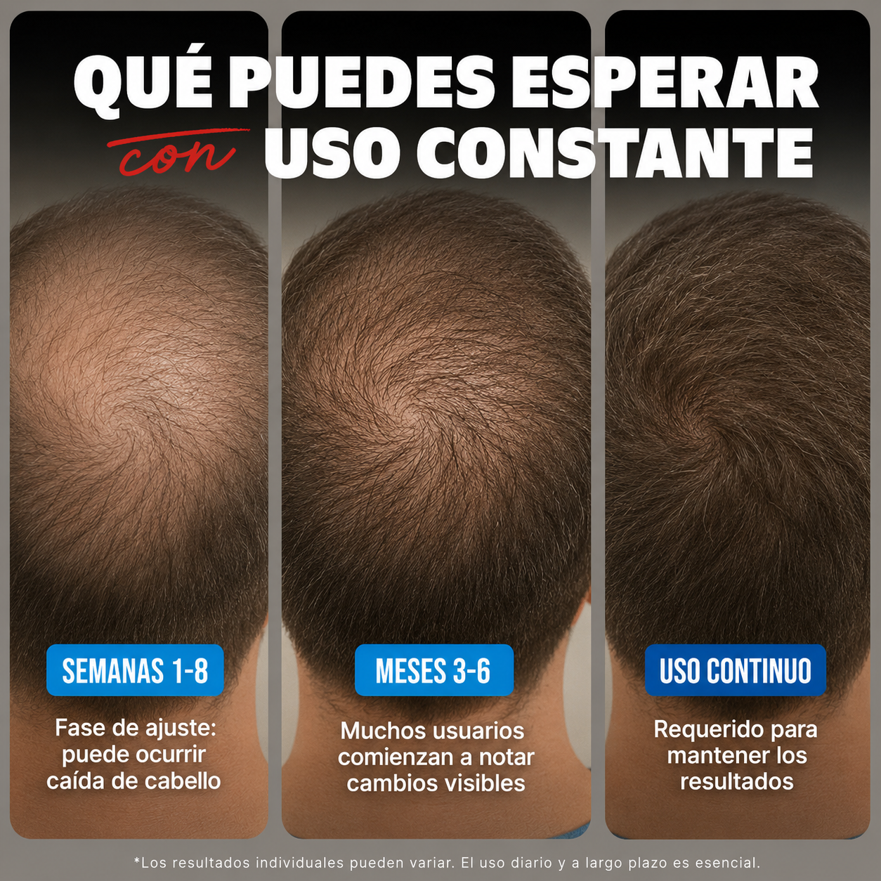 Kirkland - Minoxidil Líquido para Hombre - Tratamiento para la Regeneración Capilar, Vello Facial y Corporal de Alta Potencia al 5 % | 60 mL